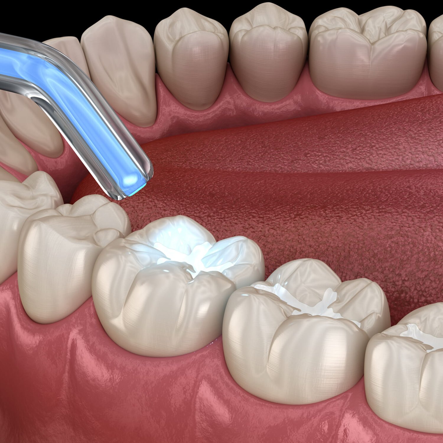 sunny-smiles-fillings-2048x1536 1